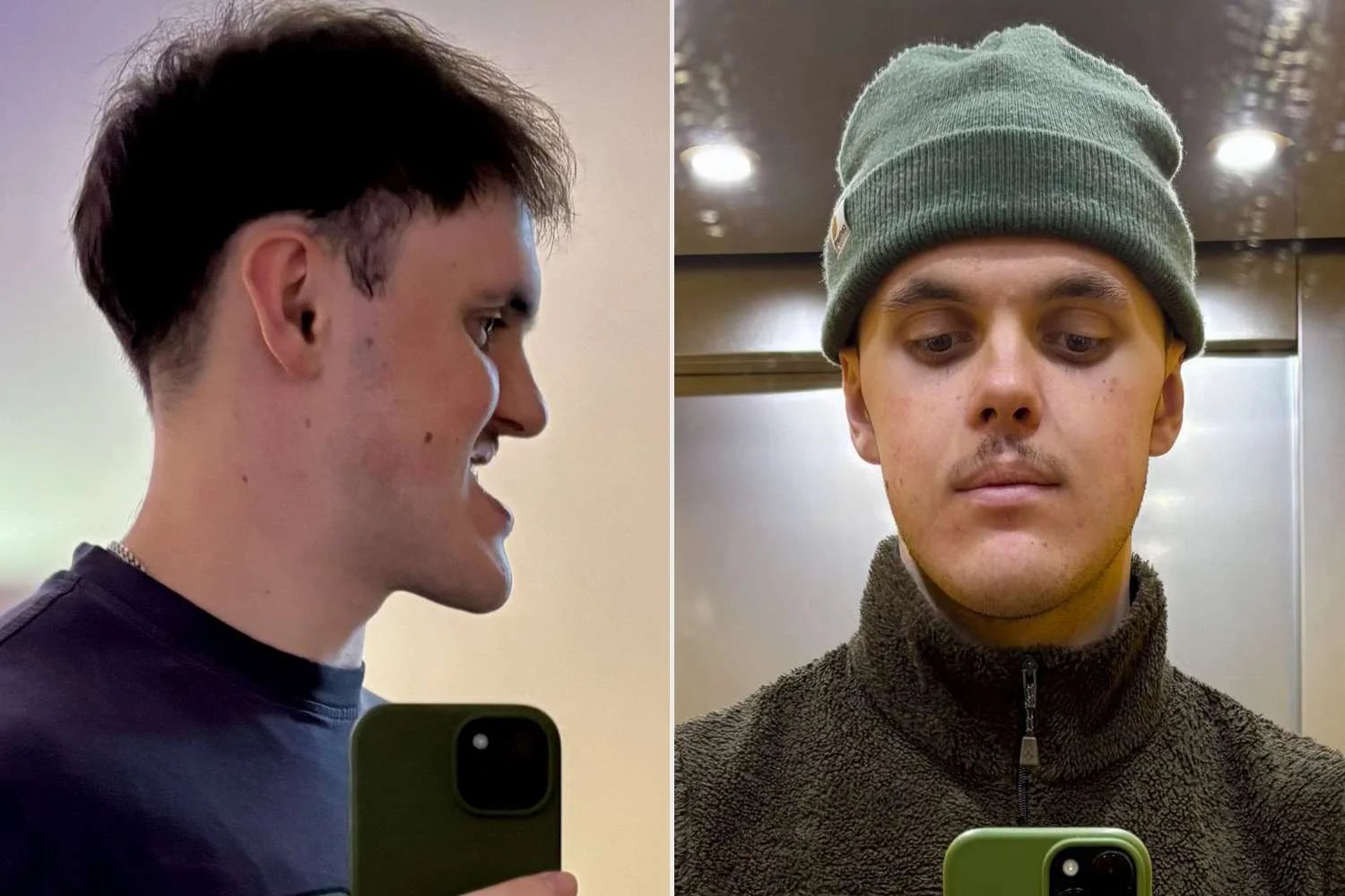 Man Bullied for Underbite Waits 6 Years for Surgery